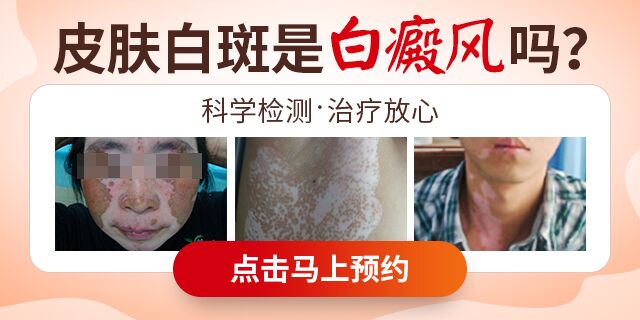 如何治疗孕妇白癜风呢
