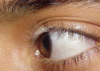 眼部白癜风治疗需注意什么