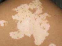 寻常型白癜风应该怎样治疗