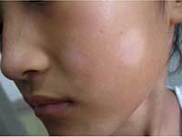 儿童患白癜风会有哪些症状表现