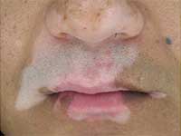 孩子出现白癜风有哪些病因